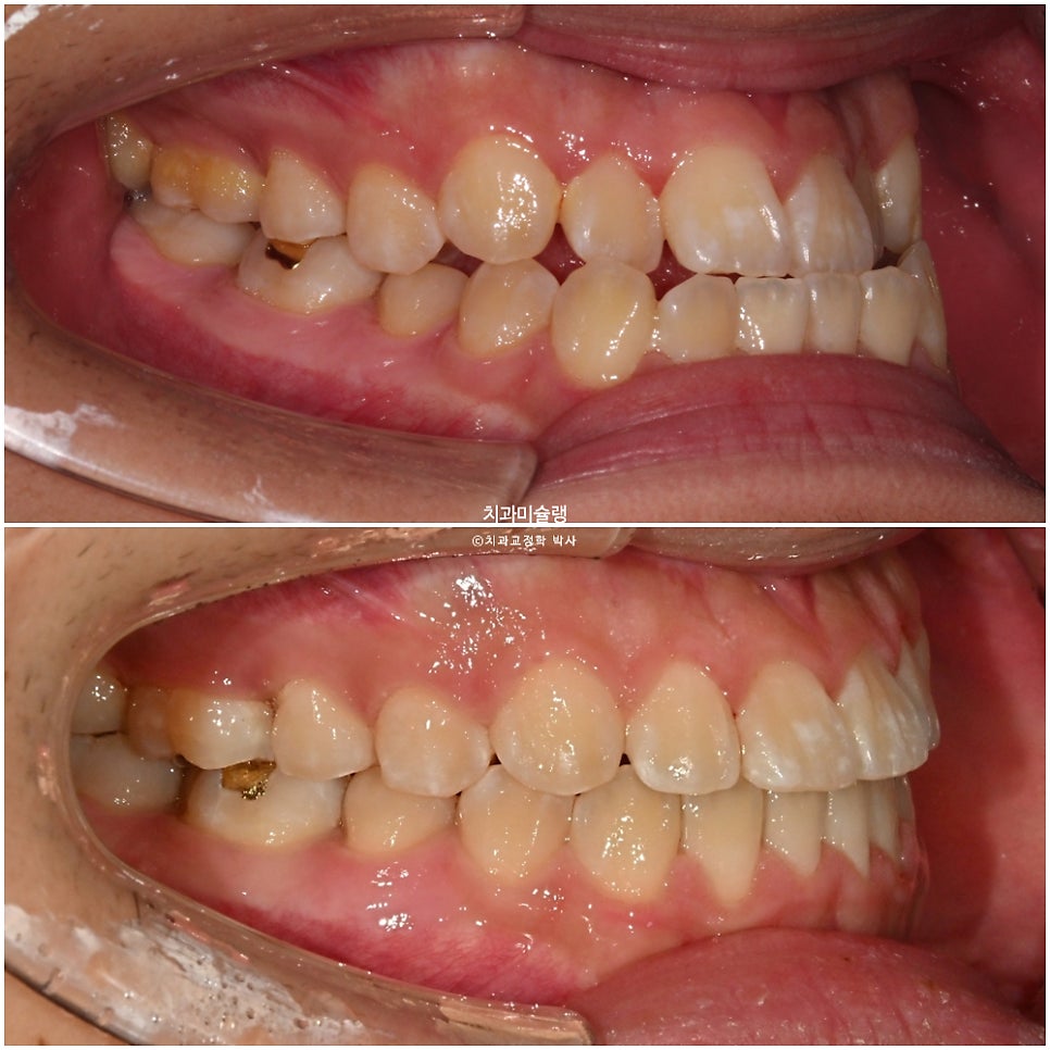 양악수술 없이 주걱턱 3급 부정교합 반대교합 비발치 비수술 절충치료 클리피씨 치료기간 1년11개월