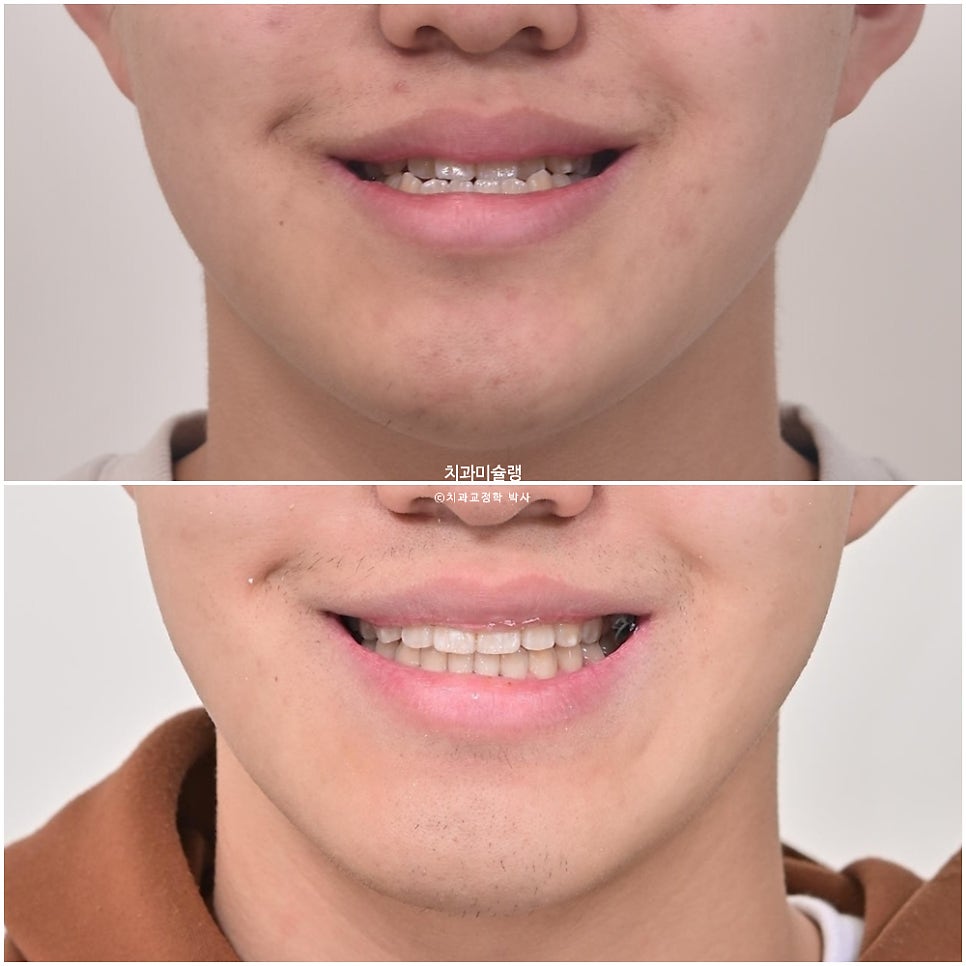 양악수술 없이 주걱턱 3급 부정교합 반대교합 비발치 비수술 절충치료 클리피씨 치료기간 1년11개월