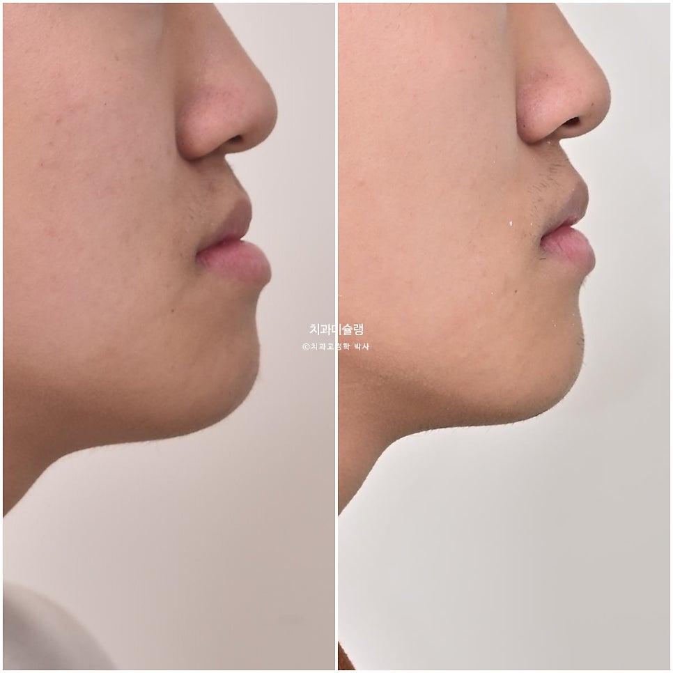양악수술 없이 주걱턱 3급 부정교합 반대교합 비발치 비수술 절충치료 클리피씨 치료기간 1년11개월