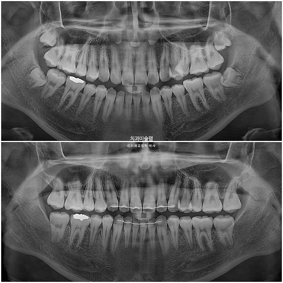 양악수술 없이 주걱턱 3급 부정교합 반대교합 비발치 비수술 절충치료 클리피씨 치료기간 1년11개월