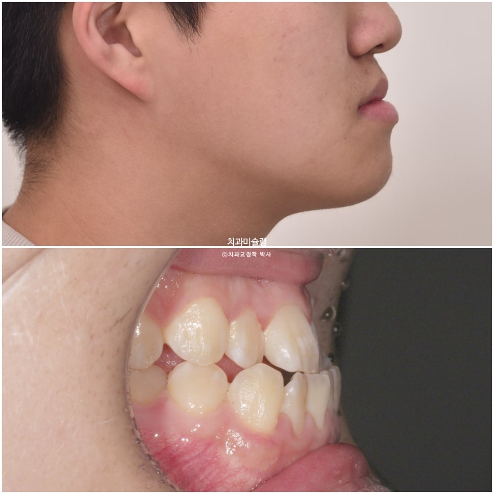 양악수술 없이 주걱턱 3급 부정교합 반대교합 비발치 비수술 절충치료 클리피씨 치료기간 1년11개월