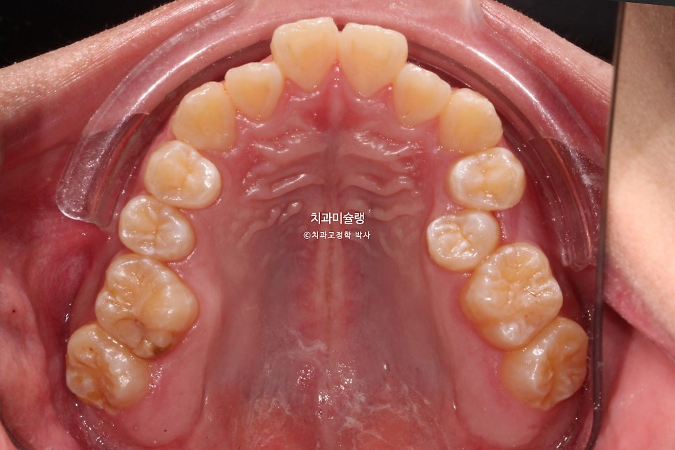 양악수술 없이 주걱턱 3급 부정교합 반대교합 비발치 비수술 절충치료 클리피씨 치료기간 1년11개월