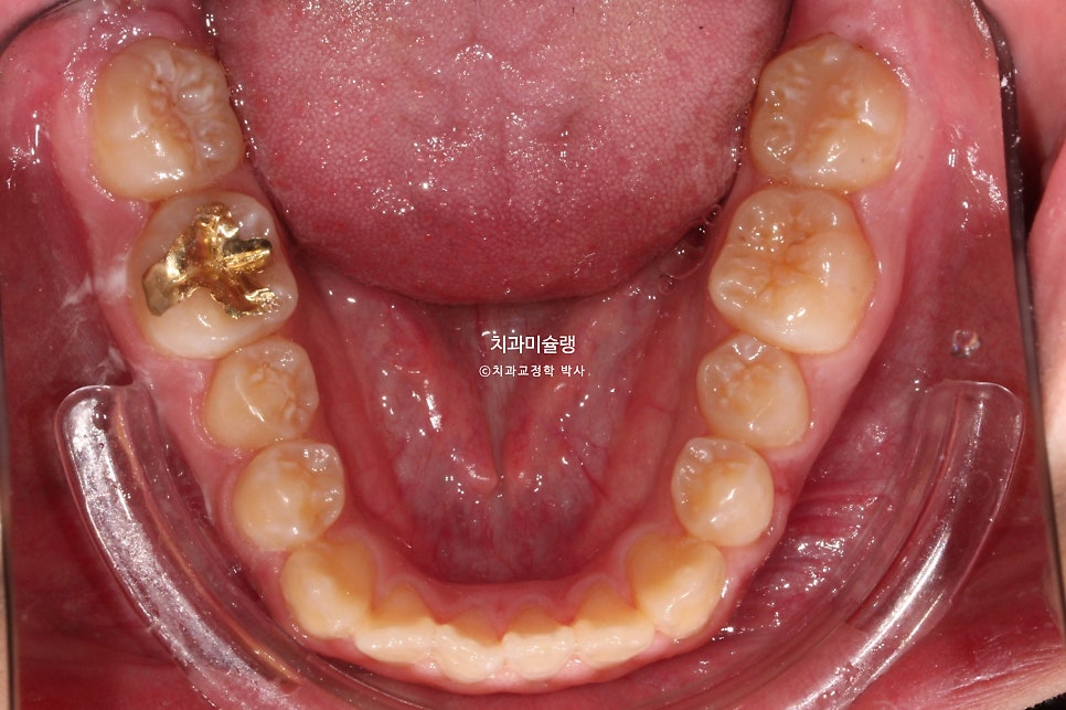 양악수술 없이 주걱턱 3급 부정교합 반대교합 비발치 비수술 절충치료 클리피씨 치료기간 1년11개월