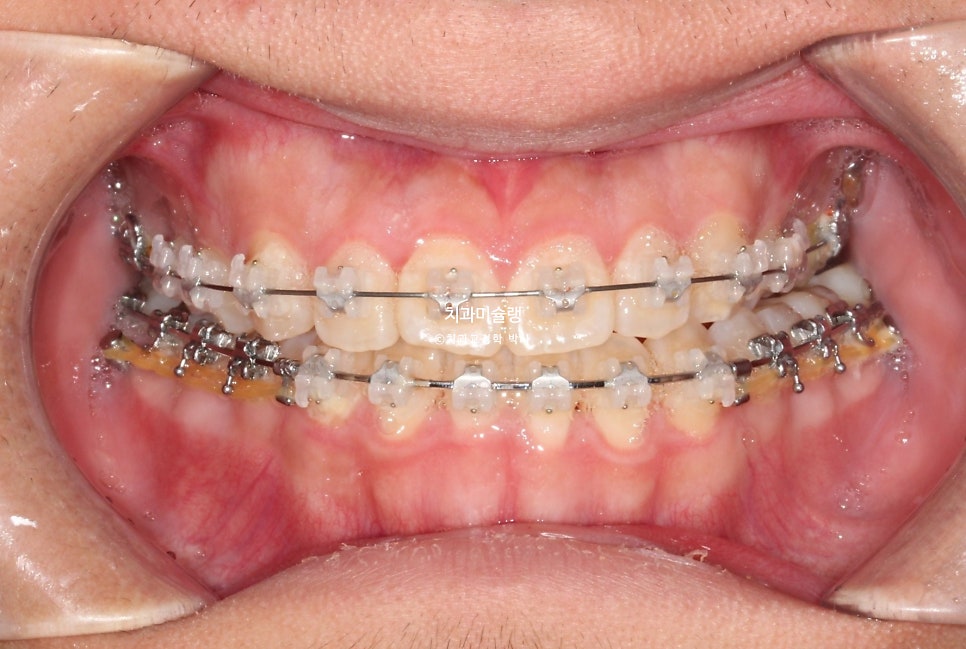 양악수술 없이 주걱턱 3급 부정교합 반대교합 비발치 비수술 절충치료 클리피씨 치료기간 1년11개월