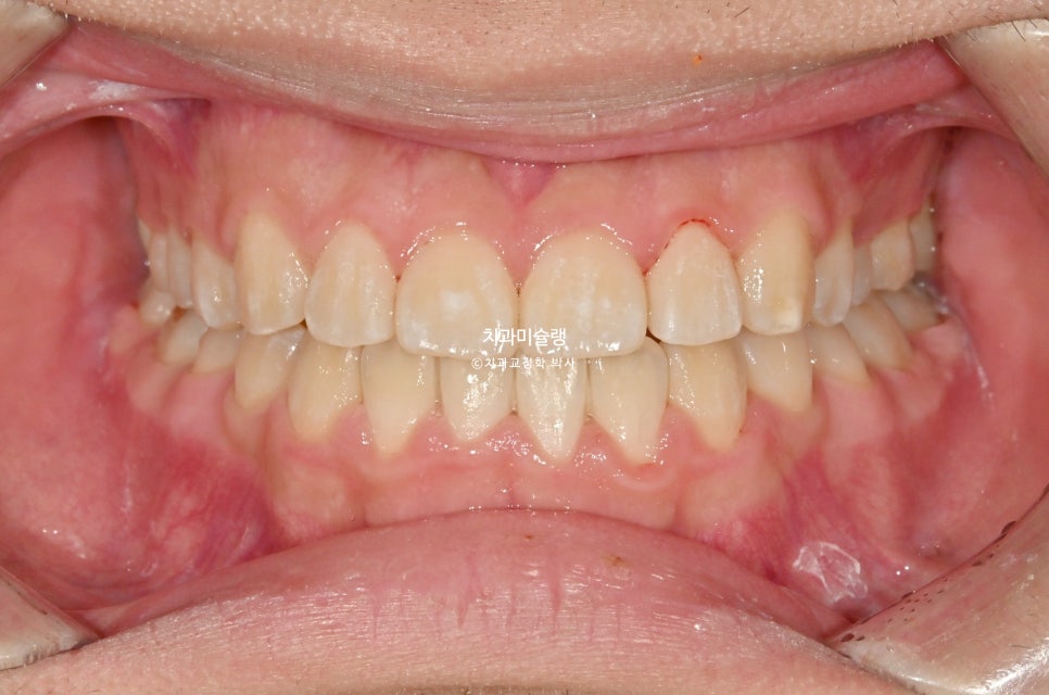 양악수술 없이 주걱턱 3급 부정교합 반대교합 비발치 비수술 절충치료 클리피씨 치료기간 1년11개월