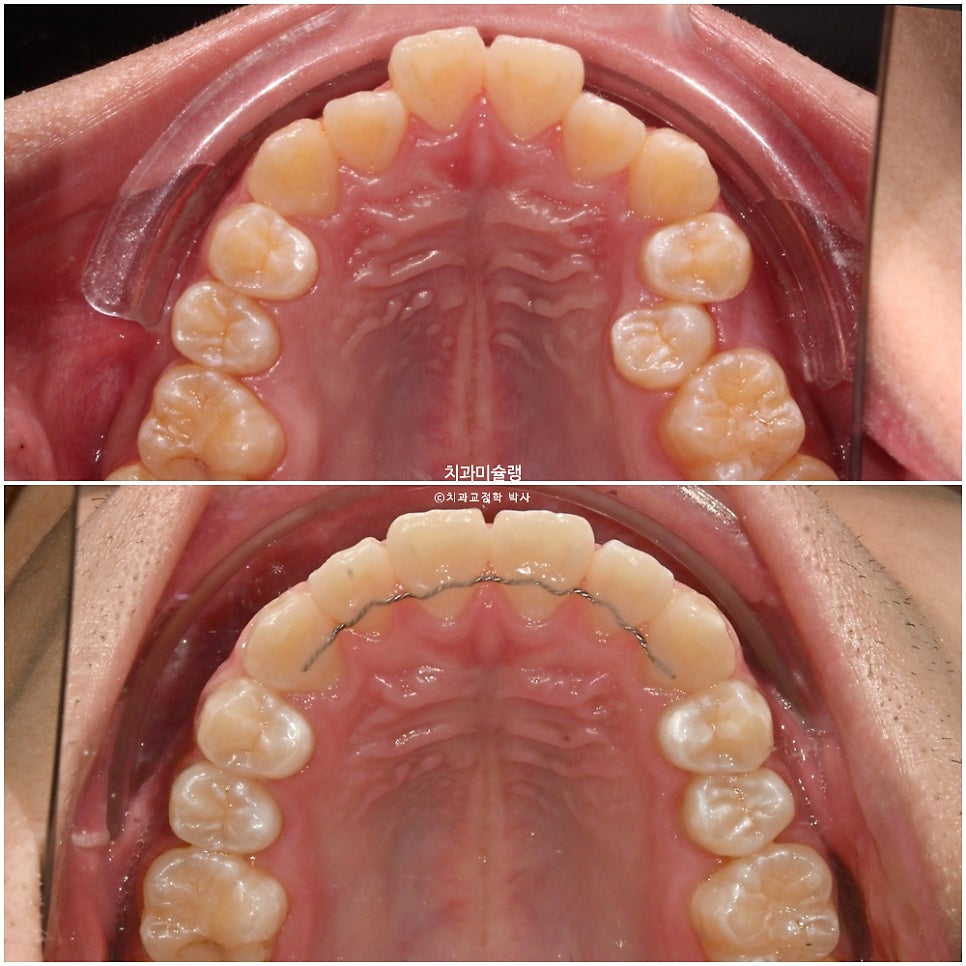 양악수술 없이 주걱턱 3급 부정교합 반대교합 비발치 비수술 절충치료 클리피씨 치료기간 1년11개월