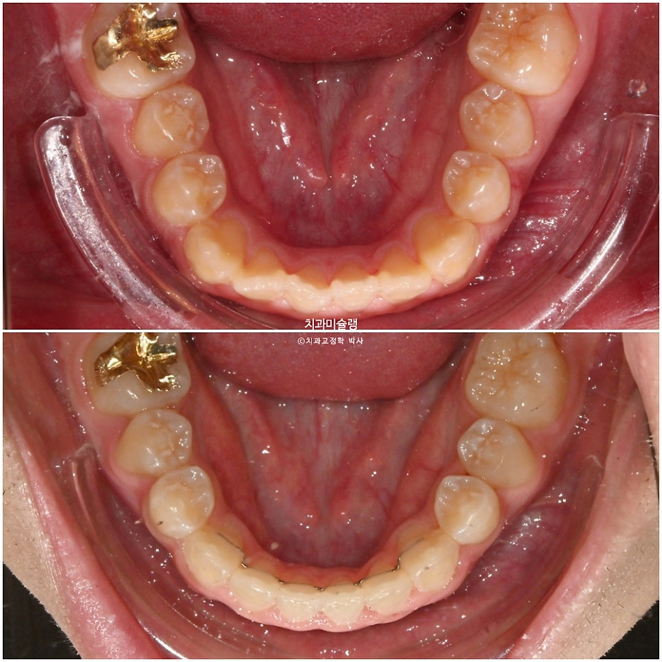 양악수술 없이 주걱턱 3급 부정교합 반대교합 비발치 비수술 절충치료 클리피씨 치료기간 1년11개월