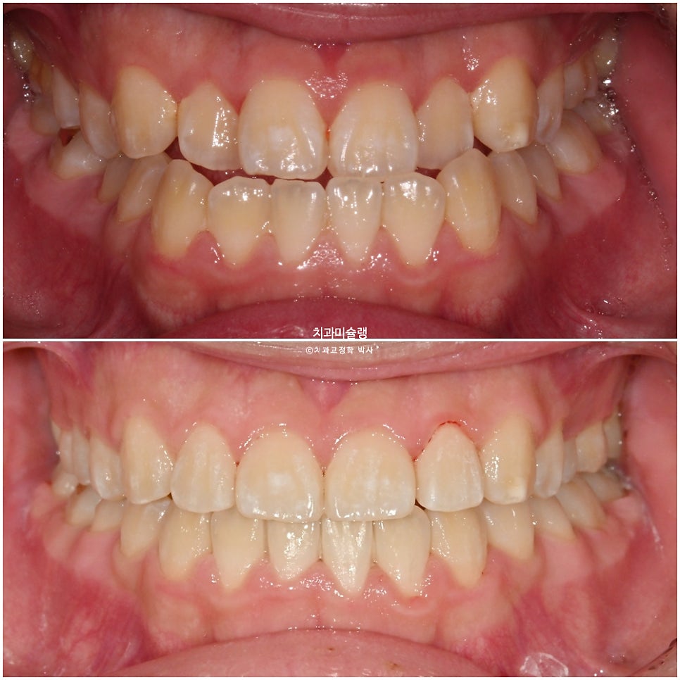 양악수술 없이 주걱턱 3급 부정교합 반대교합 비발치 비수술 절충치료 클리피씨 치료기간 1년11개월