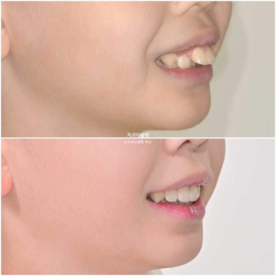 해외거주 유학생 돌출 과개교합 덧니 중심선 인비절라인 퍼스트 어린이 소아 교정 치료기간 2년4개월 재제작 1회