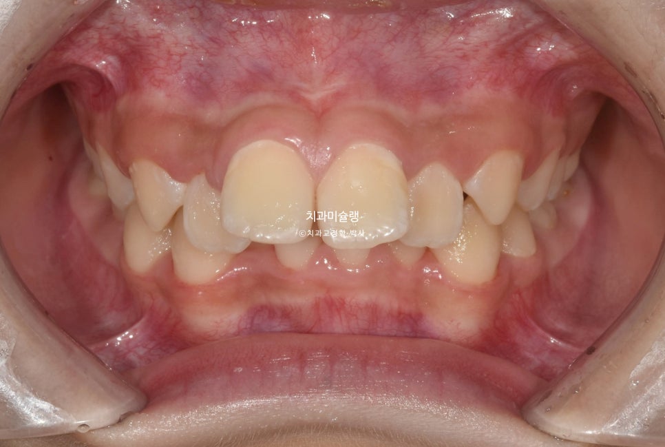 해외거주 유학생 돌출 과개교합 덧니 중심선 인비절라인 퍼스트 어린이 소아 교정 치료기간 2년4개월 재제작 1회