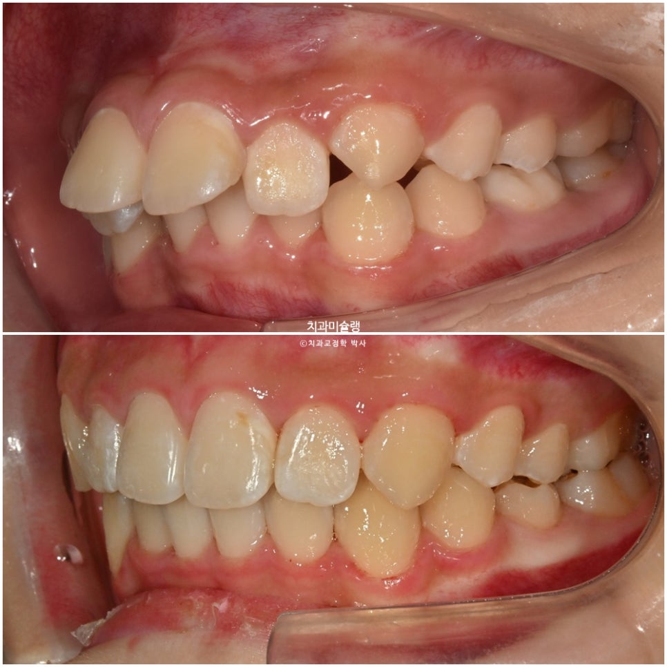 해외거주 유학생 돌출 과개교합 덧니 중심선 인비절라인 퍼스트 어린이 소아 교정 치료기간 2년4개월 재제작 1회