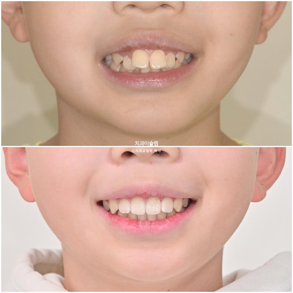 해외거주 유학생 돌출 과개교합 덧니 중심선 인비절라인 퍼스트 어린이 소아 교정 치료기간 2년4개월 재제작 1회