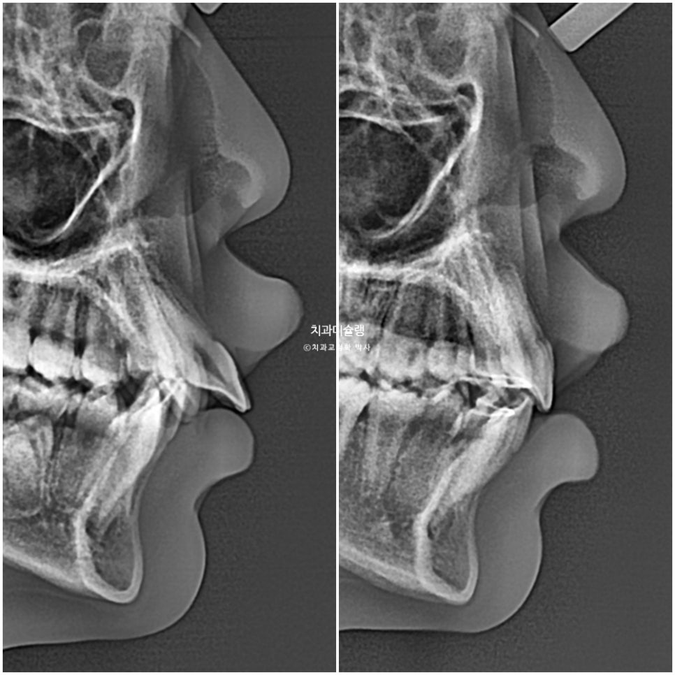 해외거주 유학생 돌출 과개교합 덧니 중심선 인비절라인 퍼스트 어린이 소아 교정 치료기간 2년4개월 재제작 1회