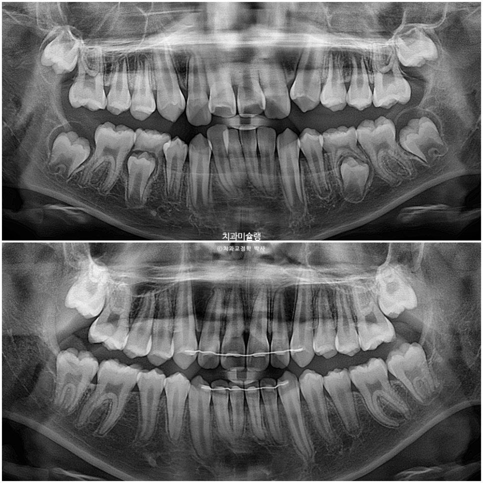 해외거주 유학생 돌출 과개교합 덧니 중심선 인비절라인 퍼스트 어린이 소아 교정 치료기간 2년4개월 재제작 1회