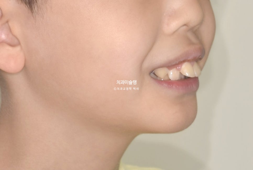 해외거주 유학생 돌출 과개교합 덧니 중심선 인비절라인 퍼스트 어린이 소아 교정 치료기간 2년4개월 재제작 1회
