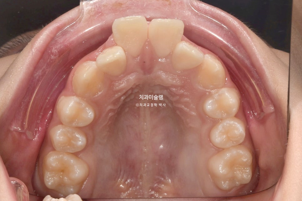 해외거주 유학생 돌출 과개교합 덧니 중심선 인비절라인 퍼스트 어린이 소아 교정 치료기간 2년4개월 재제작 1회