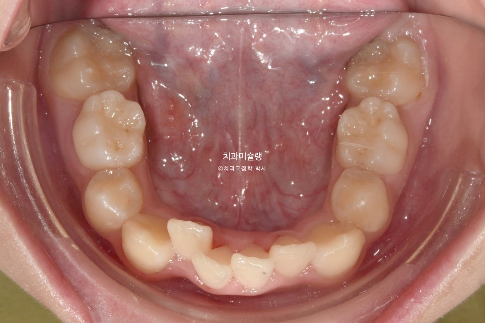 해외거주 유학생 돌출 과개교합 덧니 중심선 인비절라인 퍼스트 어린이 소아 교정 치료기간 2년4개월 재제작 1회