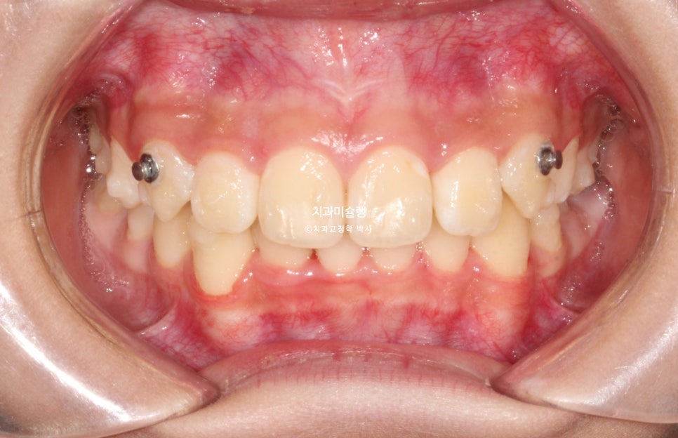 해외거주 유학생 돌출 과개교합 덧니 중심선 인비절라인 퍼스트 어린이 소아 교정 치료기간 2년4개월 재제작 1회