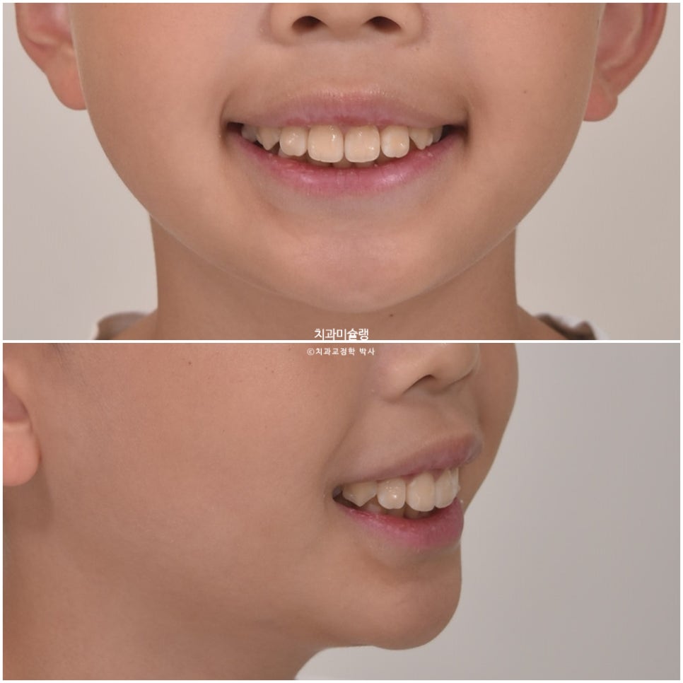 해외거주 유학생 돌출 과개교합 덧니 중심선 인비절라인 퍼스트 어린이 소아 교정 치료기간 2년4개월 재제작 1회