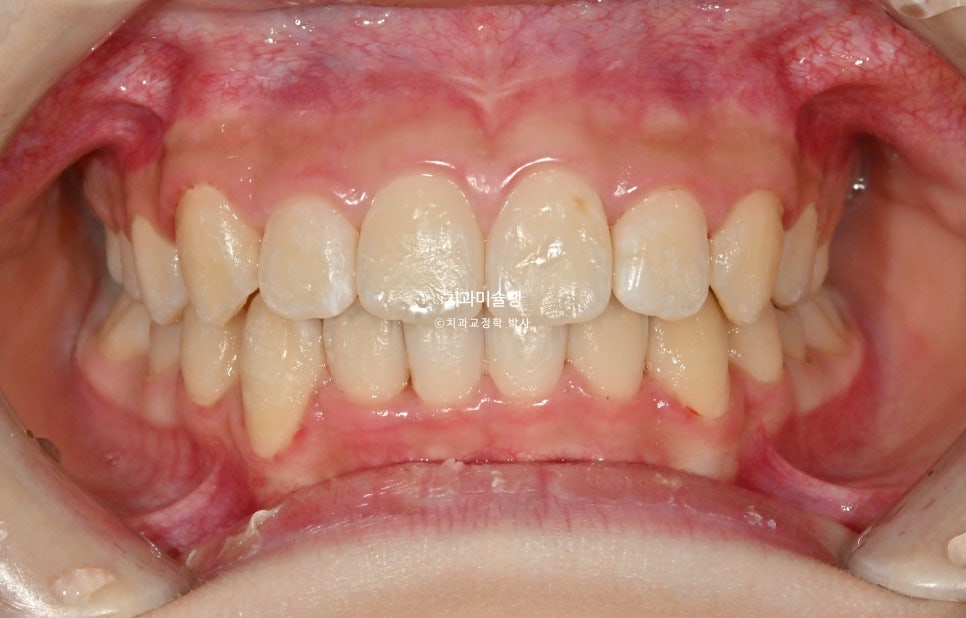 해외거주 유학생 돌출 과개교합 덧니 중심선 인비절라인 퍼스트 어린이 소아 교정 치료기간 2년4개월 재제작 1회