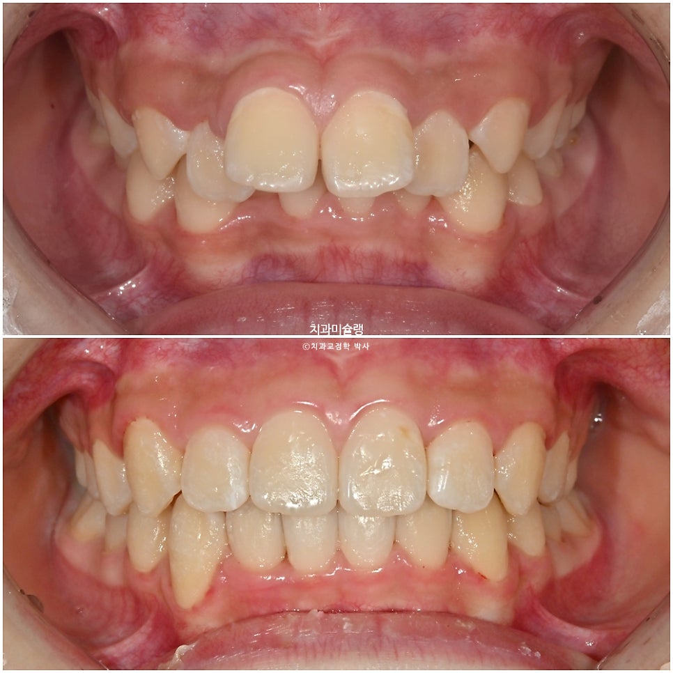 해외거주 유학생 돌출 과개교합 덧니 중심선 인비절라인 퍼스트 어린이 소아 교정 치료기간 2년4개월 재제작 1회