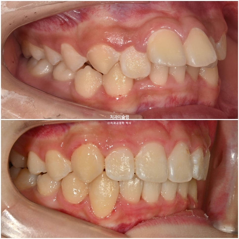 해외거주 유학생 돌출 과개교합 덧니 중심선 인비절라인 퍼스트 어린이 소아 교정 치료기간 2년4개월 재제작 1회