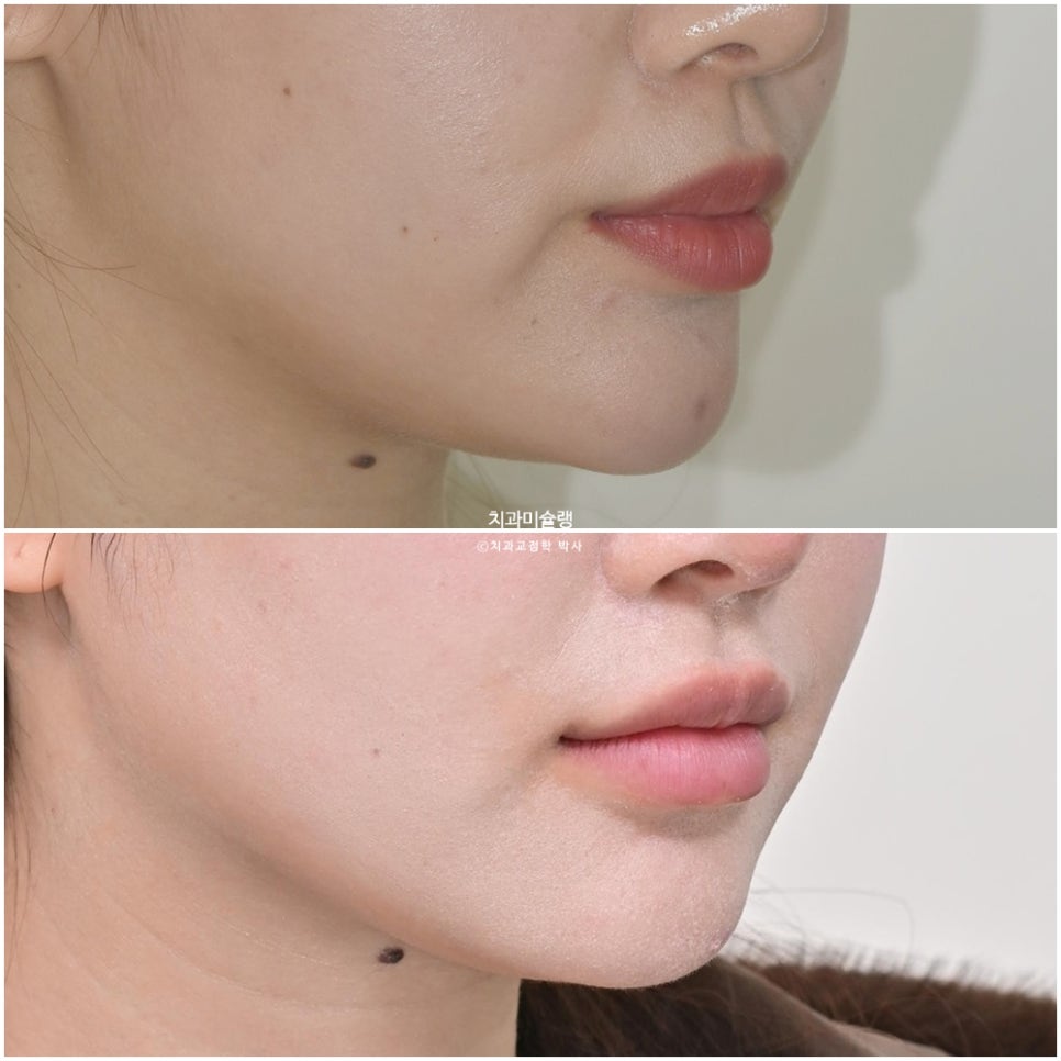 돌출입 인비절라인 발치교정 스마일라인 재제작 3회 치료기간 3년2개월