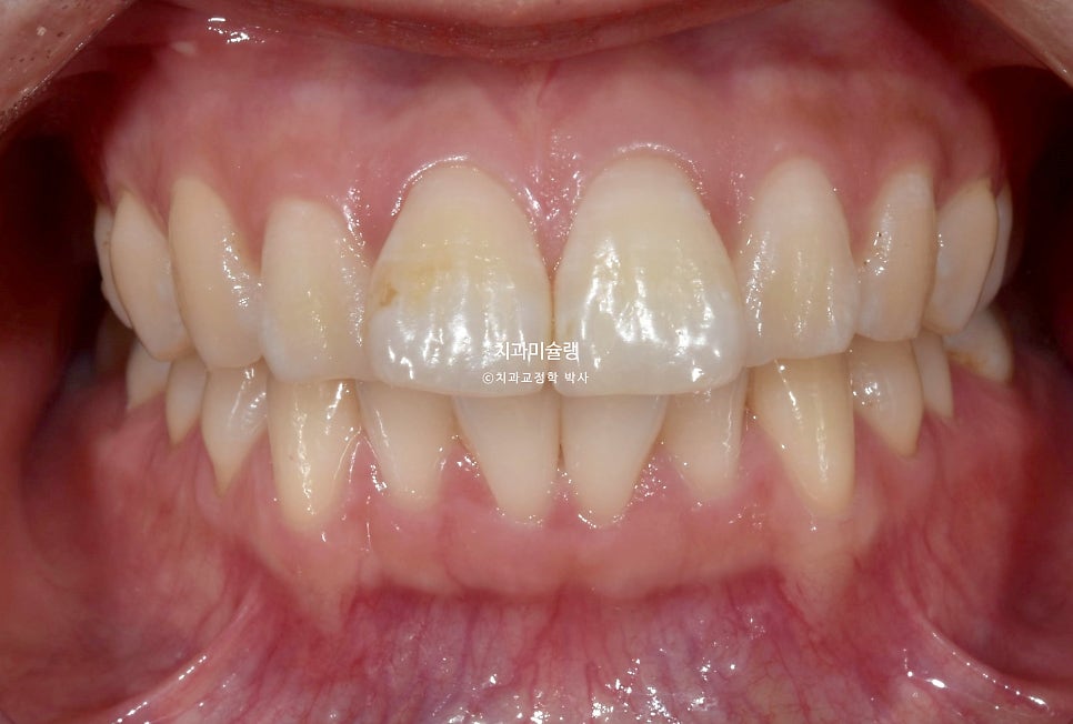 돌출입 인비절라인 발치교정 스마일라인 재제작 3회 치료기간 3년2개월