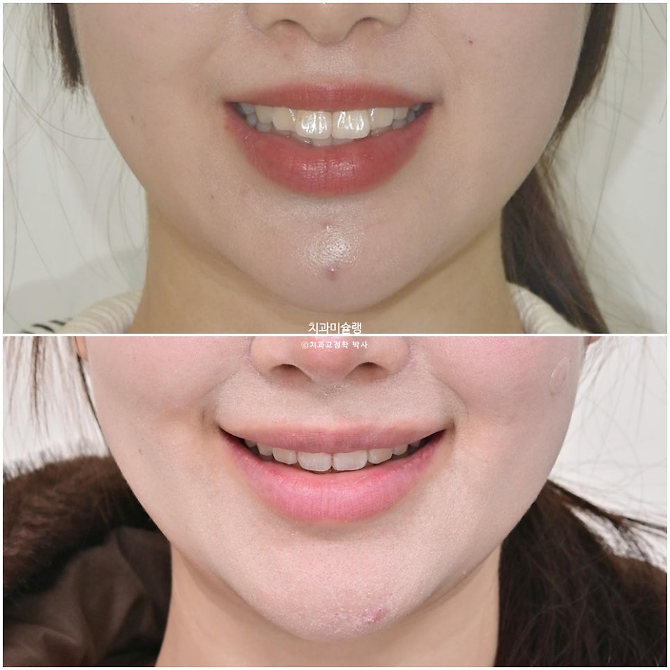 돌출입 인비절라인 발치교정 스마일라인 재제작 3회 치료기간 3년2개월