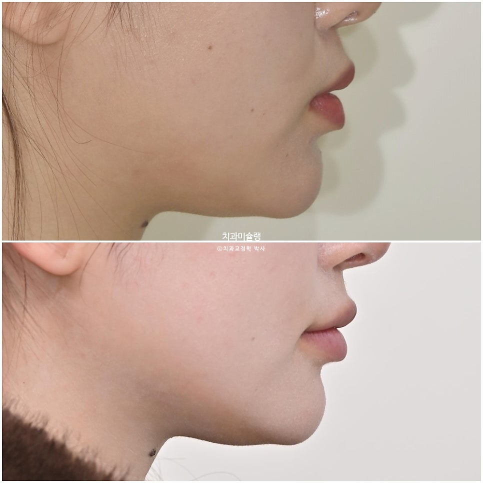 돌출입 인비절라인 발치교정 스마일라인 재제작 3회 치료기간 3년2개월