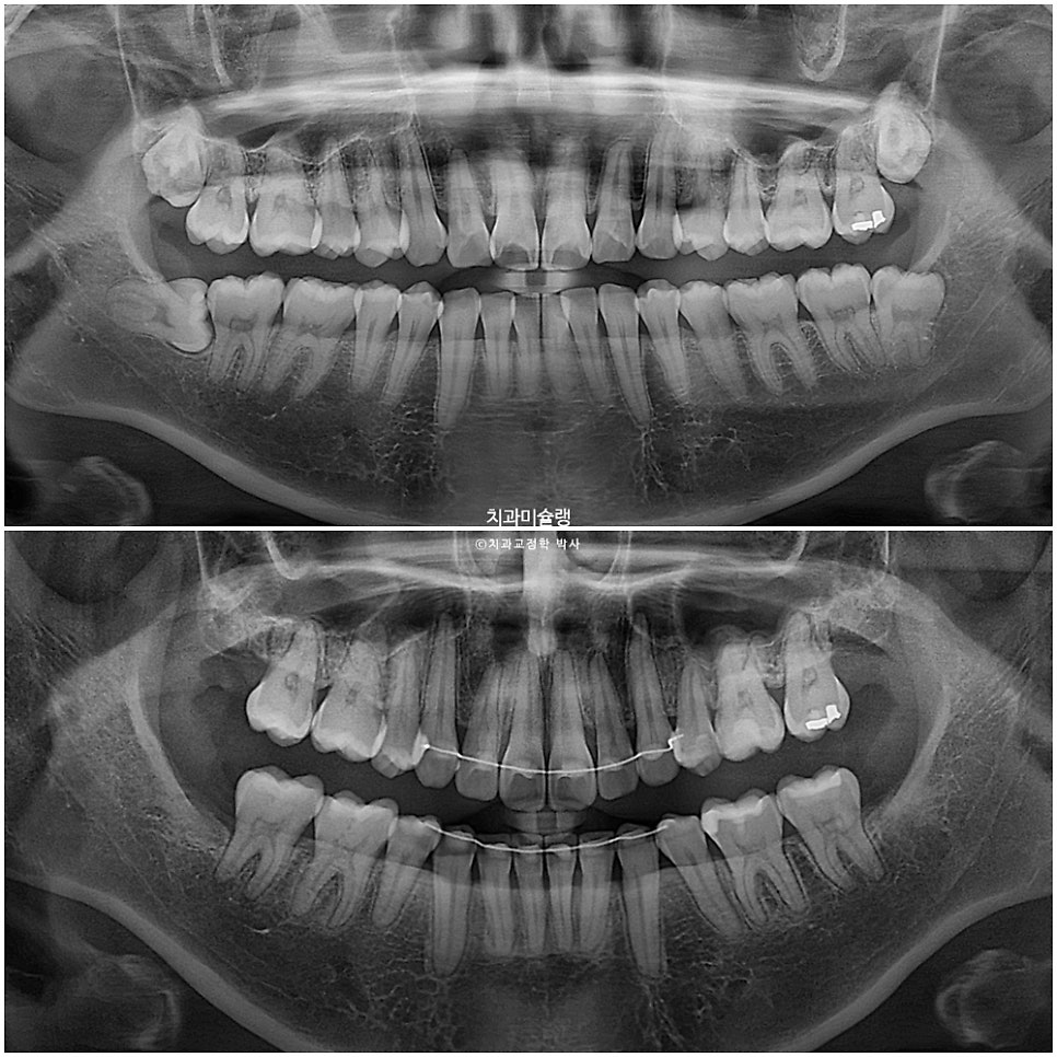 돌출입 인비절라인 발치교정 스마일라인 재제작 3회 치료기간 3년2개월