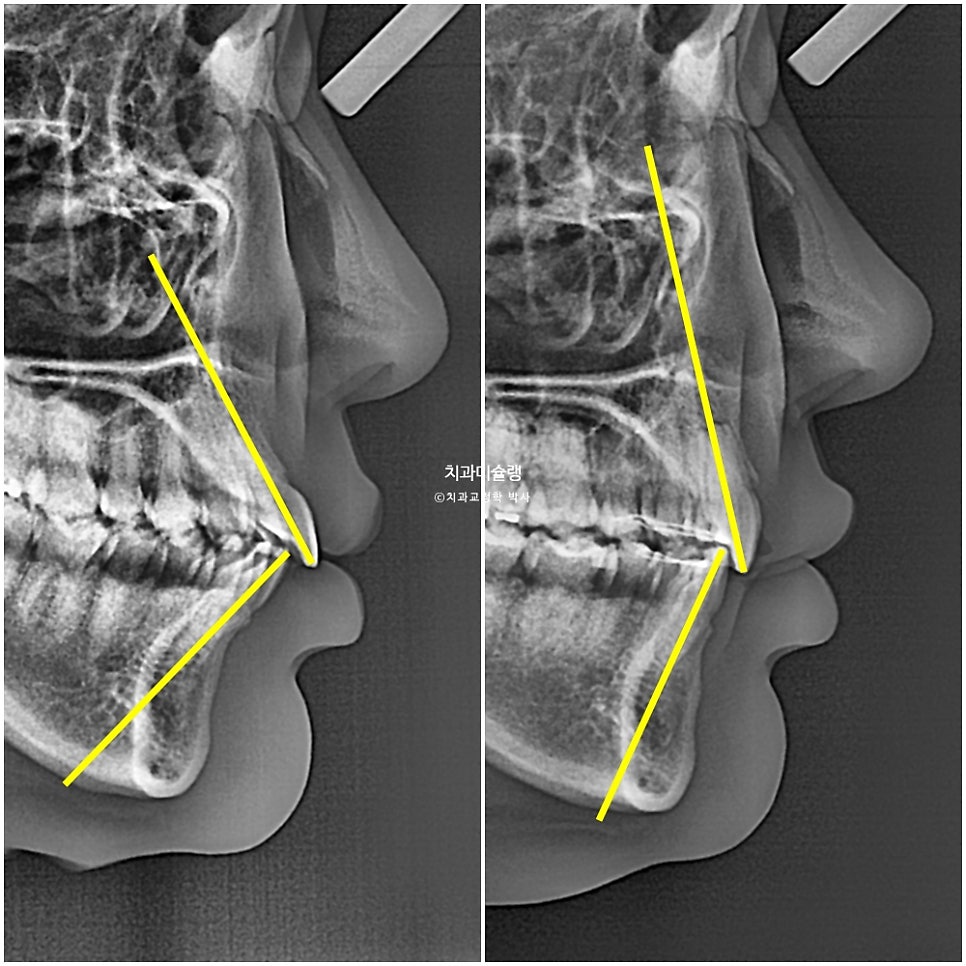 돌출입 인비절라인 발치교정 스마일라인 재제작 3회 치료기간 3년2개월