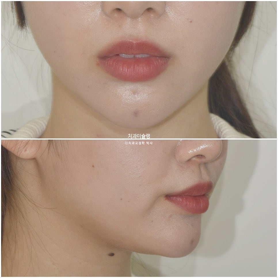 돌출입 인비절라인 발치교정 스마일라인 재제작 3회 치료기간 3년2개월