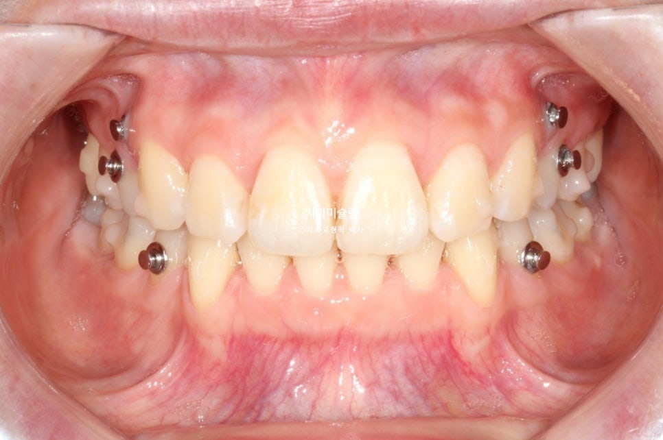 돌출입 인비절라인 발치교정 스마일라인 재제작 3회 치료기간 3년2개월