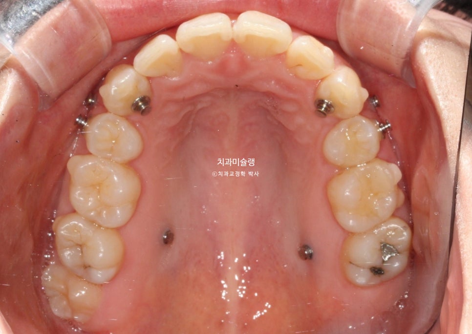 돌출입 인비절라인 발치교정 스마일라인 재제작 3회 치료기간 3년2개월