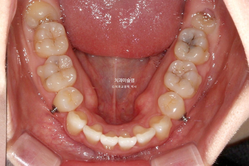 돌출입 인비절라인 발치교정 스마일라인 재제작 3회 치료기간 3년2개월
