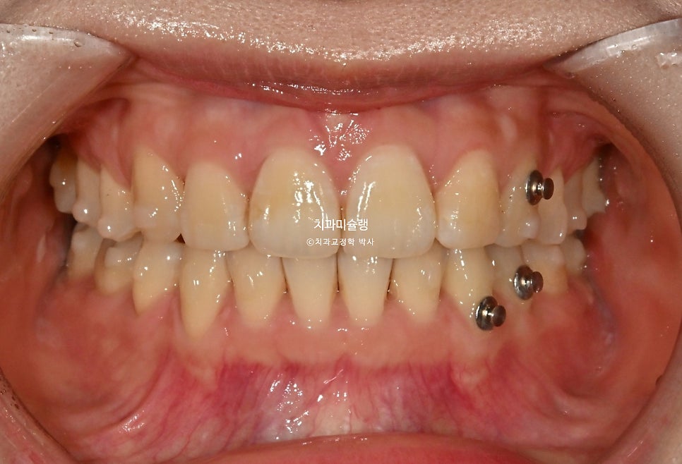 돌출입 인비절라인 발치교정 스마일라인 재제작 3회 치료기간 3년2개월