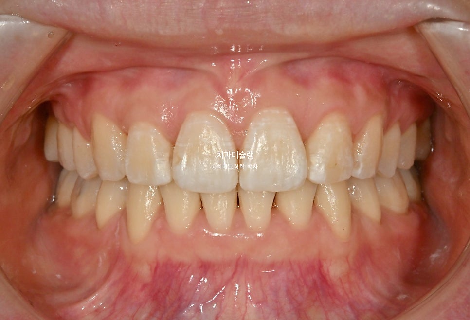 돌출입 인비절라인 발치교정 스마일라인 재제작 3회 치료기간 3년2개월