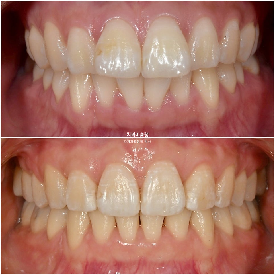 돌출입 인비절라인 발치교정 스마일라인 재제작 3회 치료기간 3년2개월
