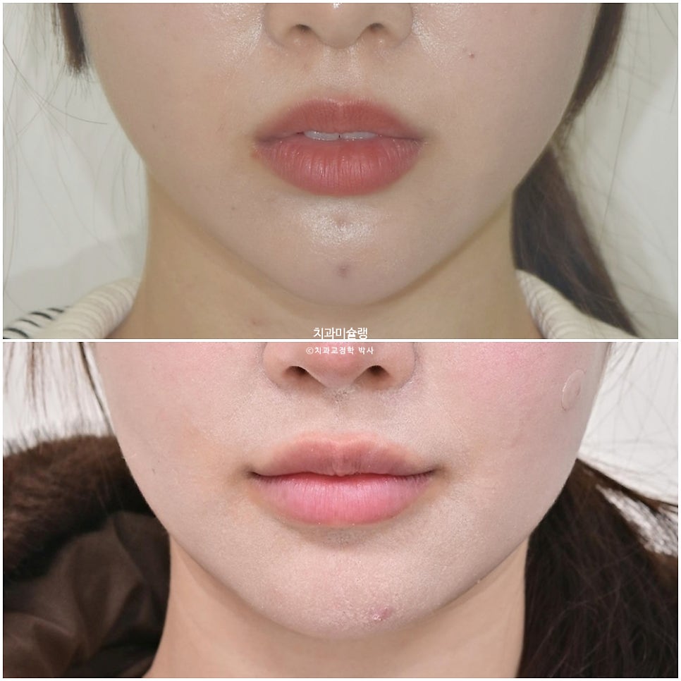 돌출입 인비절라인 발치교정 스마일라인 재제작 3회 치료기간 3년2개월