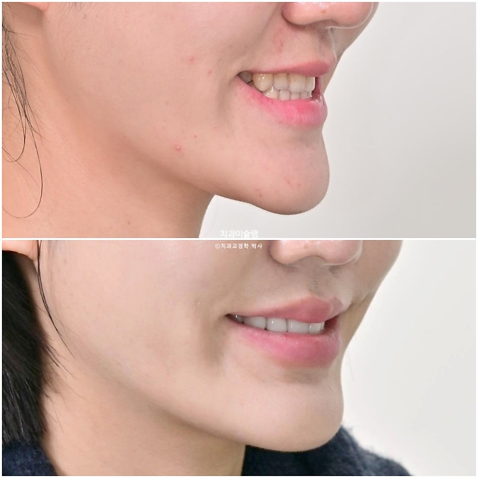 인비절라인 익스프레스 단기 교정 후 무삭제 라미네이트 젤라미 치료