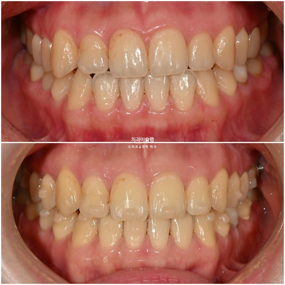 인비절라인 익스프레스 단기 교정 후 무삭제 라미네이트 젤라미 치료