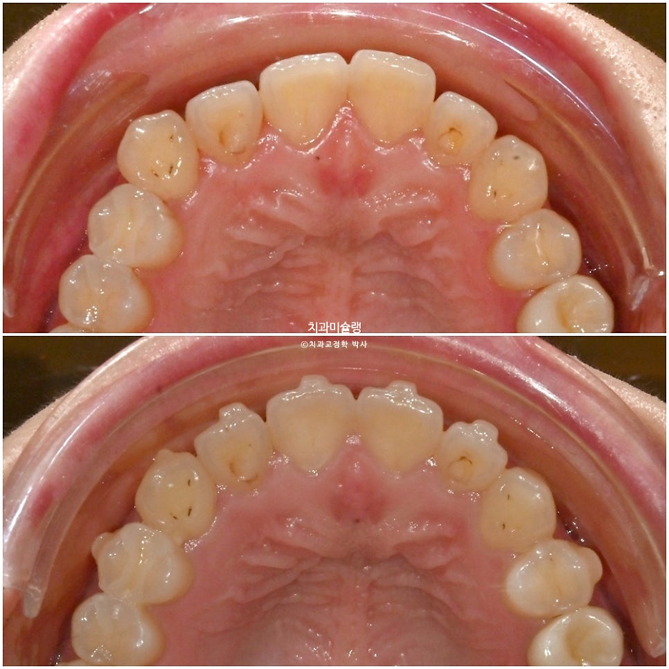 인비절라인 익스프레스 단기 교정 후 무삭제 라미네이트 젤라미 치료