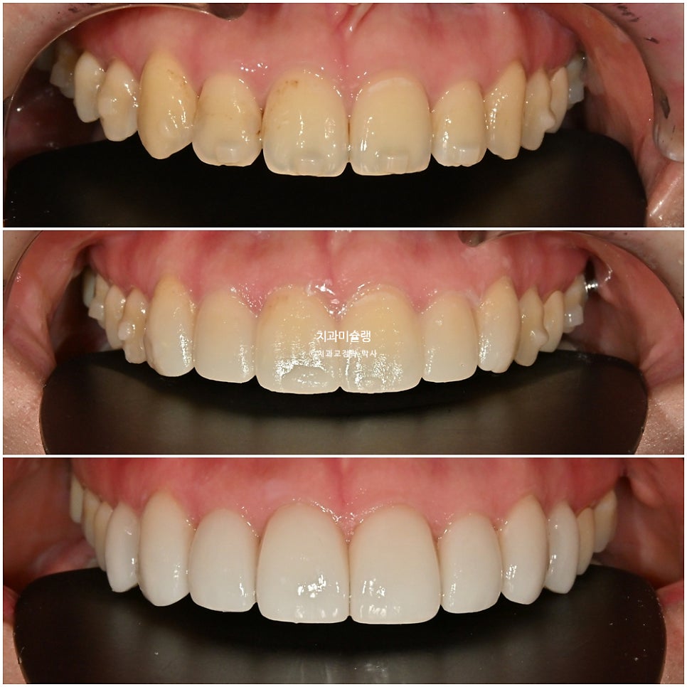 인비절라인 익스프레스 단기 교정 후 무삭제 라미네이트 젤라미 치료