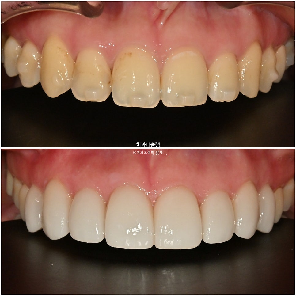 인비절라인 익스프레스 단기 교정 후 무삭제 라미네이트 젤라미 치료