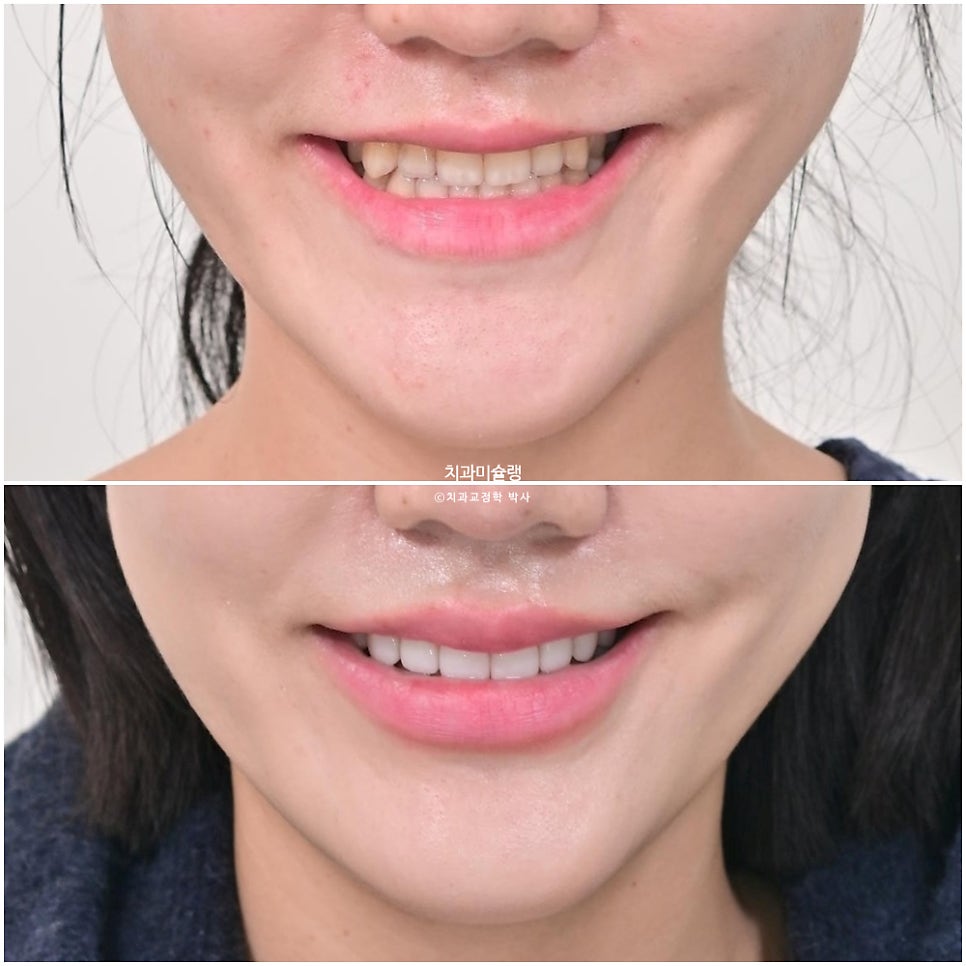 인비절라인 익스프레스 단기 교정 후 무삭제 라미네이트 젤라미 치료