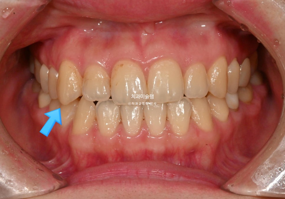 인비절라인 익스프레스 단기 교정 후 무삭제 라미네이트 젤라미 치료