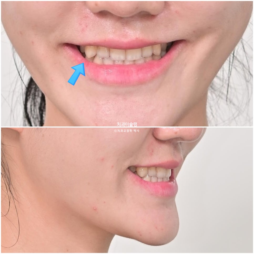 인비절라인 익스프레스 단기 교정 후 무삭제 라미네이트 젤라미 치료