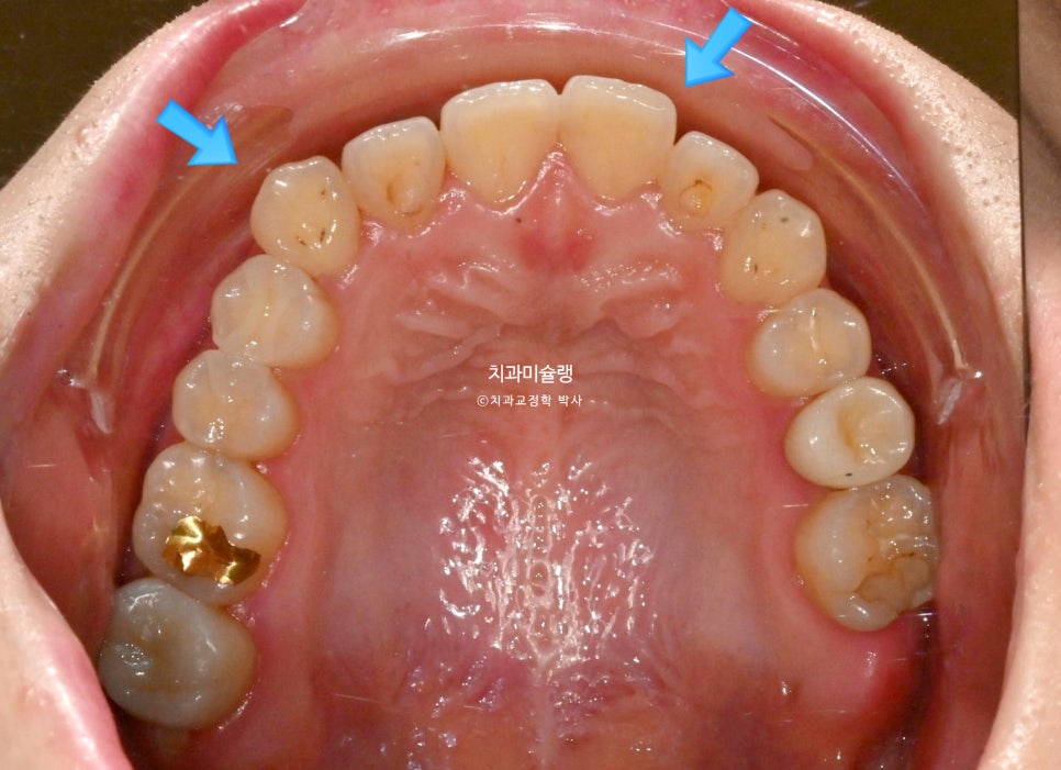 인비절라인 익스프레스 단기 교정 후 무삭제 라미네이트 젤라미 치료