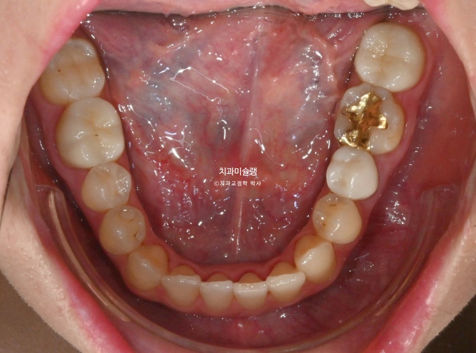 인비절라인 익스프레스 단기 교정 후 무삭제 라미네이트 젤라미 치료